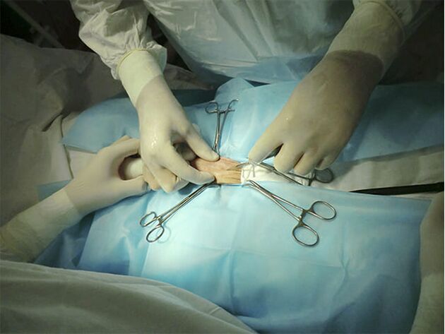 Chirurgie de marire a penisului